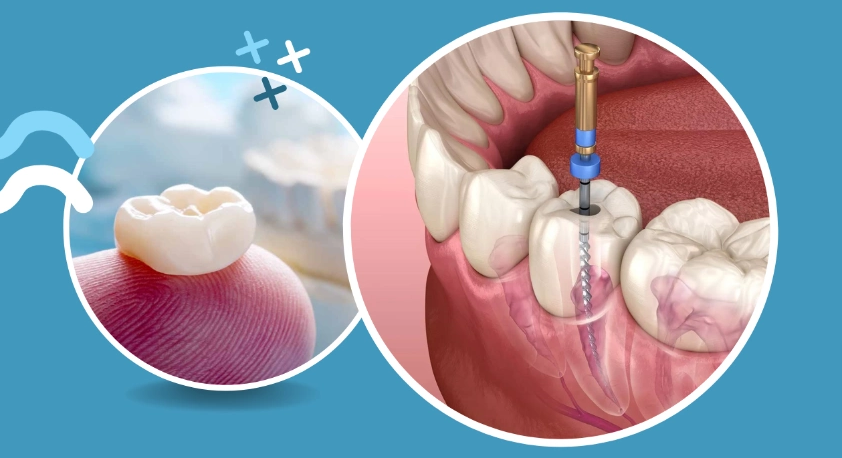 How To Perform A Root Canal
